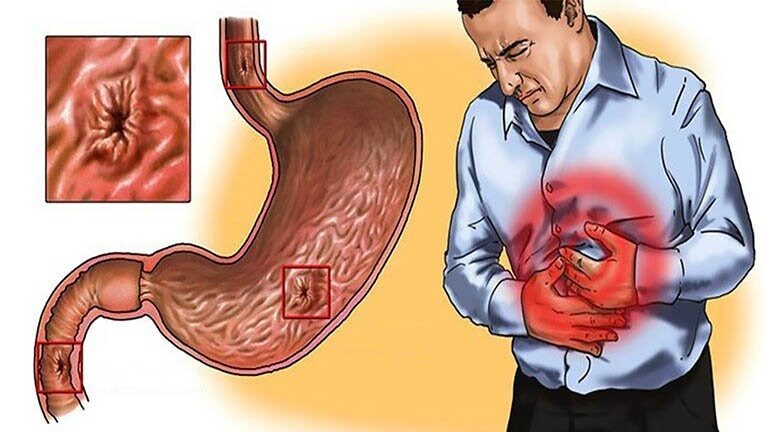 Loét dạ dày có thể gây nhiều biến chứng nguy hiểm.
