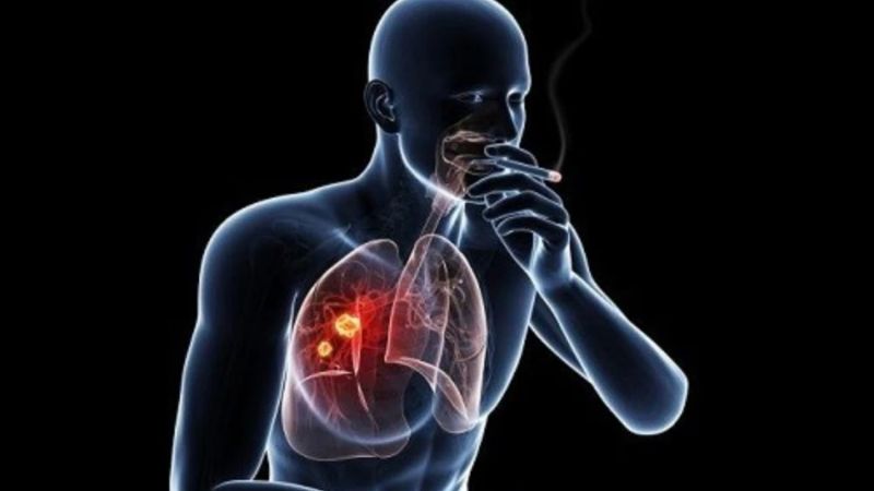Nguyên nhân gây ra các triệu chứng ung thư phổi