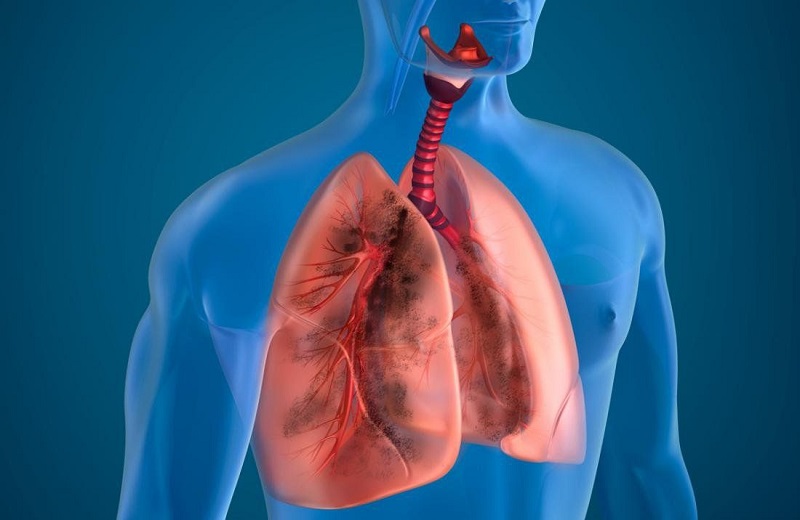 Bệnh phổi tắc nghẽn mạn tính (COPD) là một tình trạng rối loạn hô hấp mạn tính