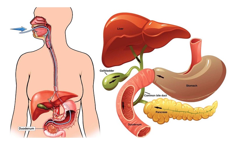 nội soi vùng mật tụy