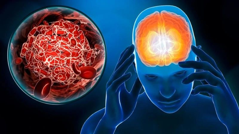 Sa sút trí tuệ mạch máu là một dạng phổ biến