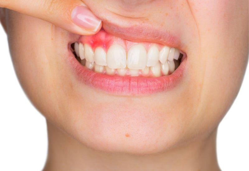 Sâu răng viêm lợi không chỉ phổ biến mà còn tác động rõ rệt đến sức khỏe và sinh hoạt hằng ngày.