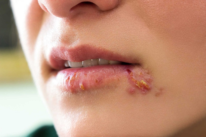 Human Papillomavirus (HPV) là một trong những nguyên nhân ung thư cổ tử cung