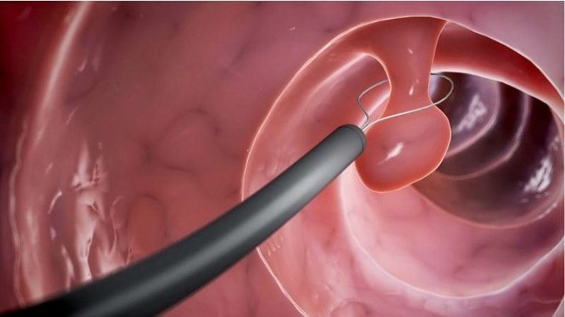 Nội soi kết hợp cắt polyp là phương pháp điều trị nhẹ nhàng, hiệu quả giúp ngăn nguy cơ tiến triển thành ung thư