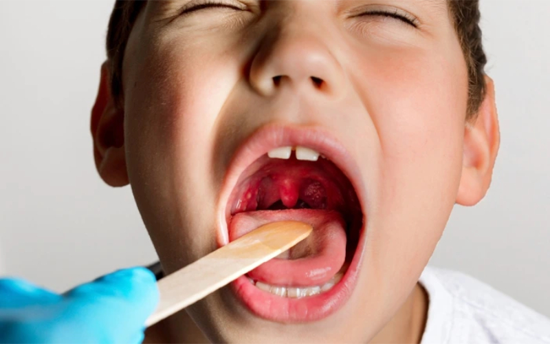 Bị viêm amidan có triệu chứng gì