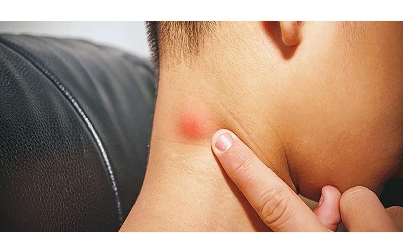 triệu chứng bệnh ung thư vòm họng 