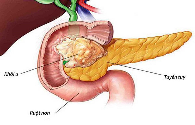 Ung thư tuyến tụy là một bệnh lý ác tính hình thành từ sự phát triển bất thường và mất kiểm soát của các tế bào trong mô tụy