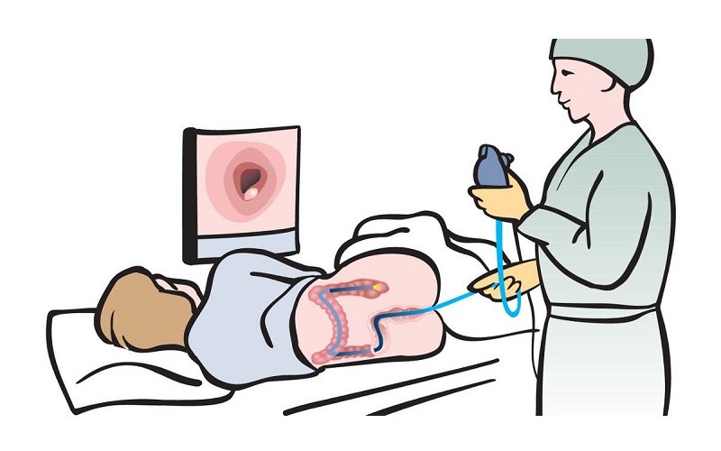 Nội soi là một trong những phương pháp chân đoán phổ biến của bệnh ung thư đại tràng 