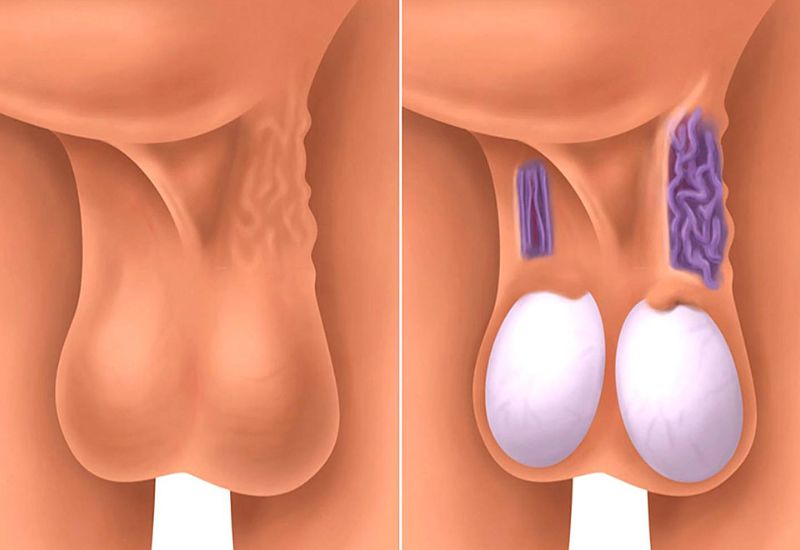Giãn tĩnh mạch thừng tinh là gì?