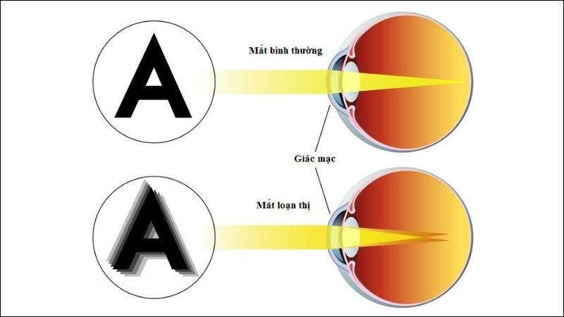 Loạn thị xảy ra khi giác mạc hoặc thủy tinh thể không có hình dạng tròn đều mà thay vào đó có dạng hình oval hoặc bất thường.