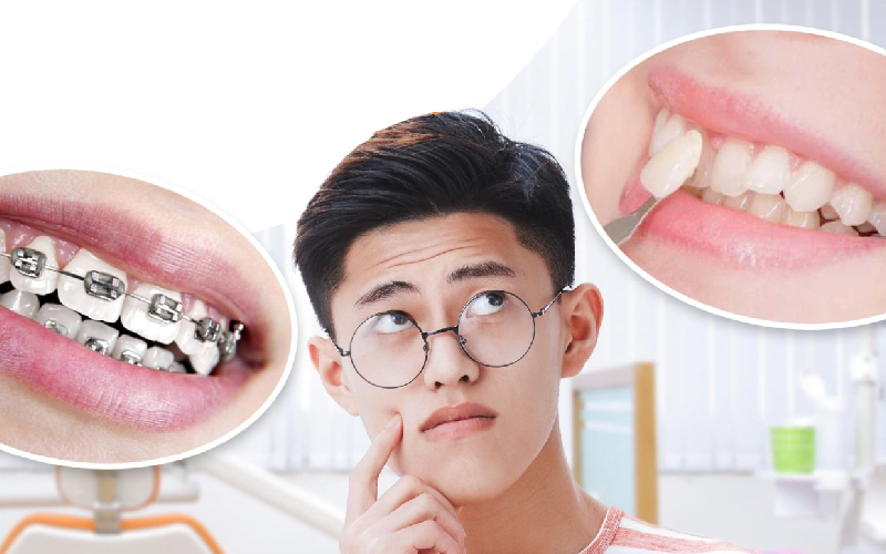 tầm 20 tuổi Nên niềng răng hay bọc sứ
