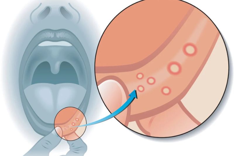 dấu hiệu nổi cục trong miệng không đau