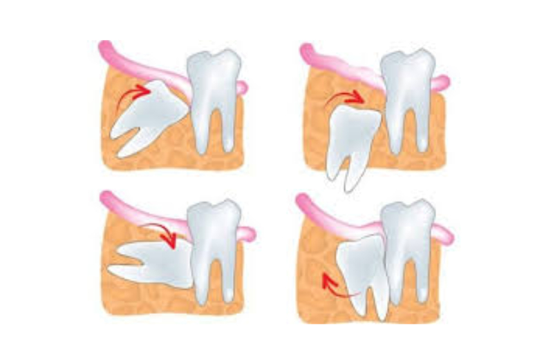 nhổ răng số 8 bao lâu thì lành hẳn