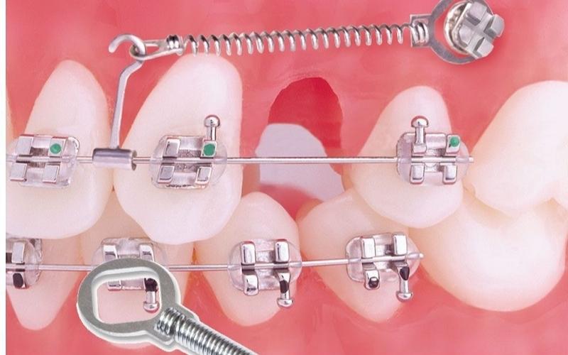 Niềng răng có đau không nếu niềng mắc cài