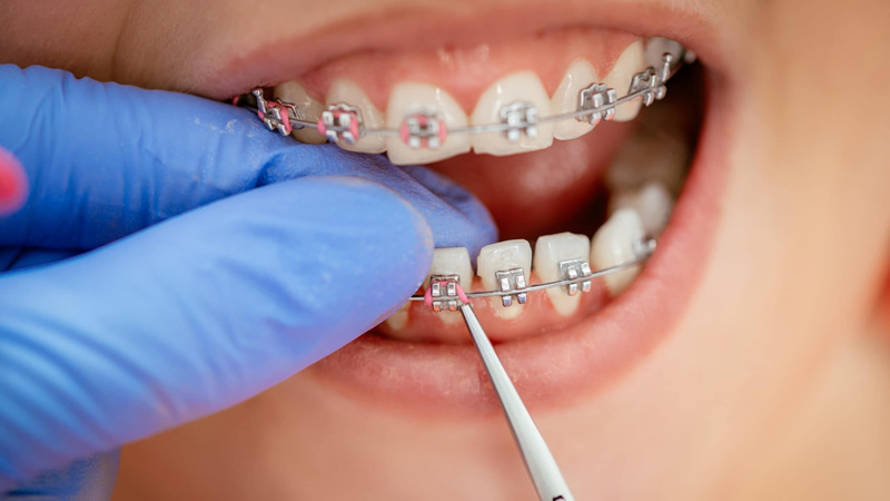 Cách thường Niềng răng có đau không