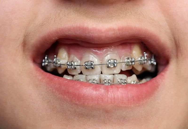 Niềng răng khểnh đang dần trở thành xu hướng thẩm mỹ được ưa chuộng hiện nay.