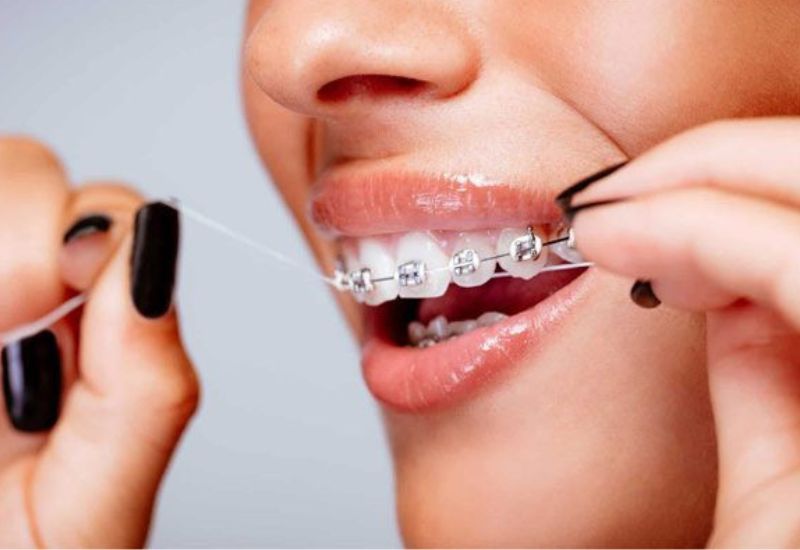 Sau khi niềng răng mắc cài, chăm sóc răng miệng đúng cách là điều không thể bỏ qua.