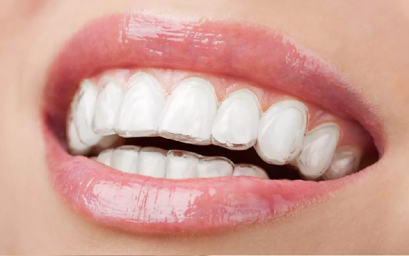 Niềng răng mất bao lâu và bao tiền
