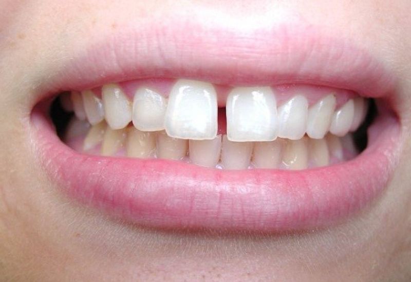 Để có hàm răng đều đẹp hơn, không ít người đã tìm đến phương pháp niềng răng thưa.