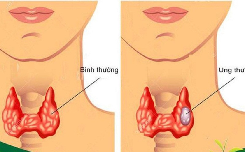 Ung thư hạch bạch huyết di căn 
