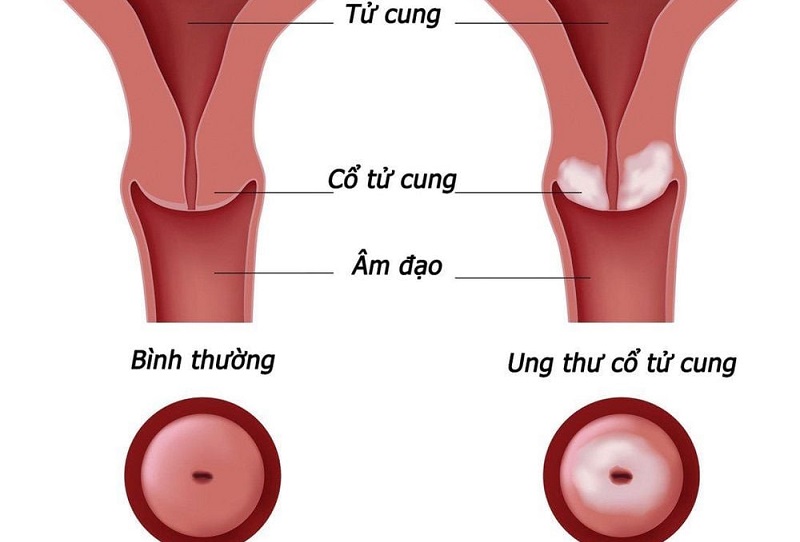 Ung thư cổ tử cung là tình trạng các tế bào tại vùng cổ tử cung tăng sinh bất thường và không kiểm soát, dẫn đến hình thành các khối u ác tính