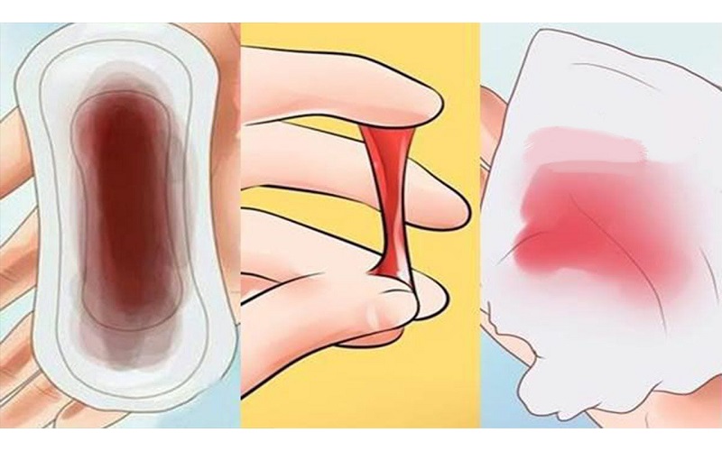 Dấu hiệu của ung thư cổ tử cung