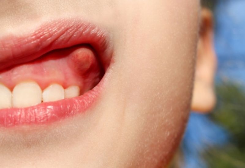 Việc trị sưng lợi cho trẻ rất quan trọng khi nguyên nhân đến từ mọc răng hoặc chăm sóc răng miệng chưa đúng