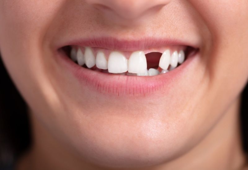 Trồng răng cửa hiện là giải pháp thẩm mỹ phổ biến, được nhiều người lựa chọn khi bị mất răng cửa.