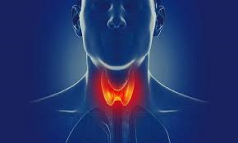 Đây là biến chứng hiếm nhưng cực kỳ nguy hiểm, xảy ra khi hormone tuyến giáp tăng vọt đột ngột