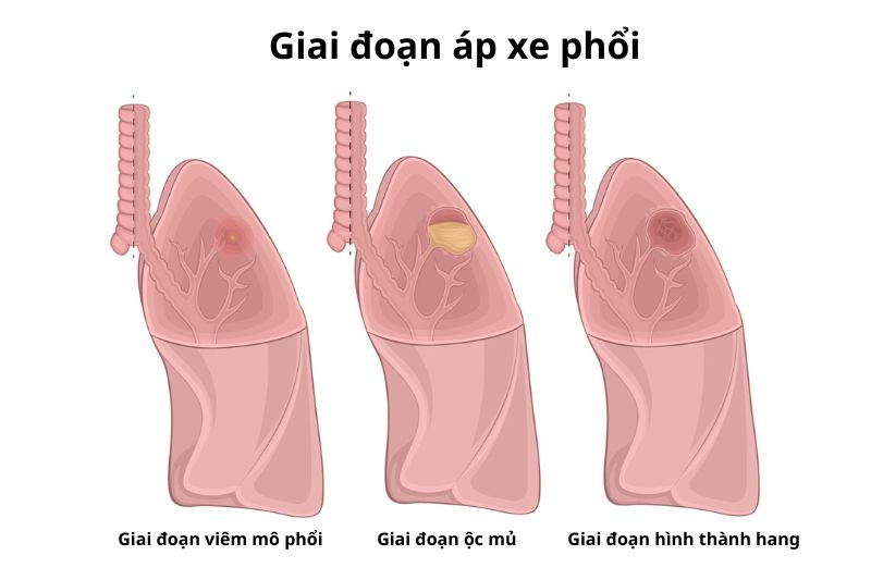 biểu hiện áp xe phổi các giai đoạn