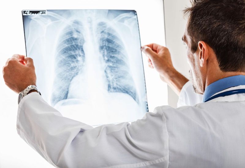 Việc điều trị ung thư phổi phụ thuộc vào giai đoạn bệnh, vị trí khối u, tình trạng di căn cũng như thể trạng tổng thể của người bệnh