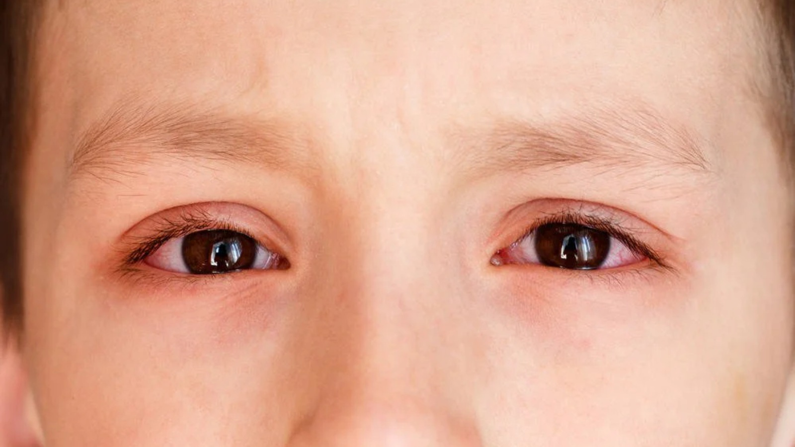 Viêm loét giác mạc là tình trạng viêm nhiễm hoặc tổn thương trên bề mặt giác mạc.