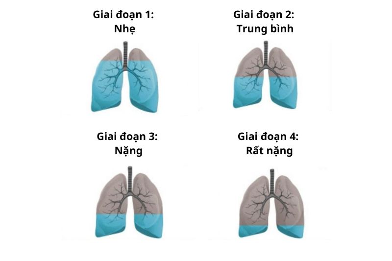 giai đoạn khi mắc COPD