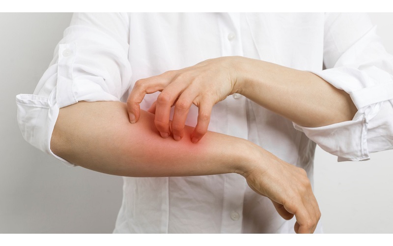 Thống kê cho thấy hơn một nửa số người mắc hen có biểu hiện của tạng Atopy - tình trạng cơ thể dễ phản ứng với các dị nguyên từ môi trường