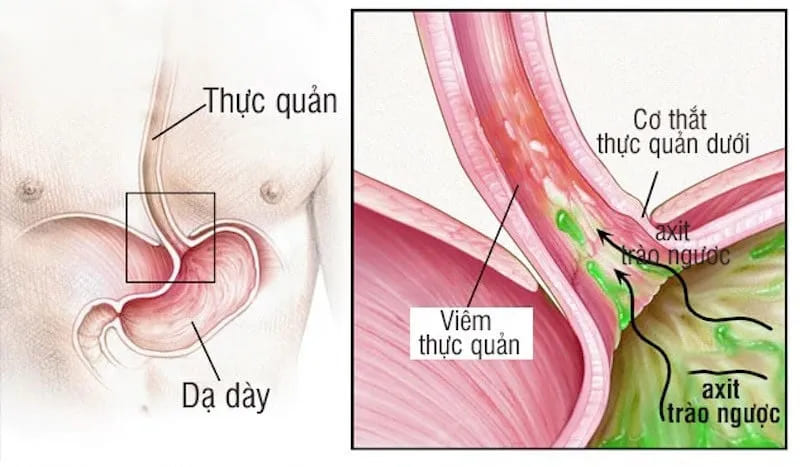 Co thắt thực quản gây khó nuốt và đau ở vùng họng