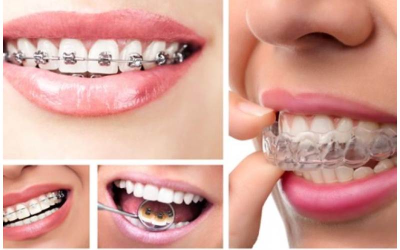 Đeo niềng răng trong bao lâu là đẹp