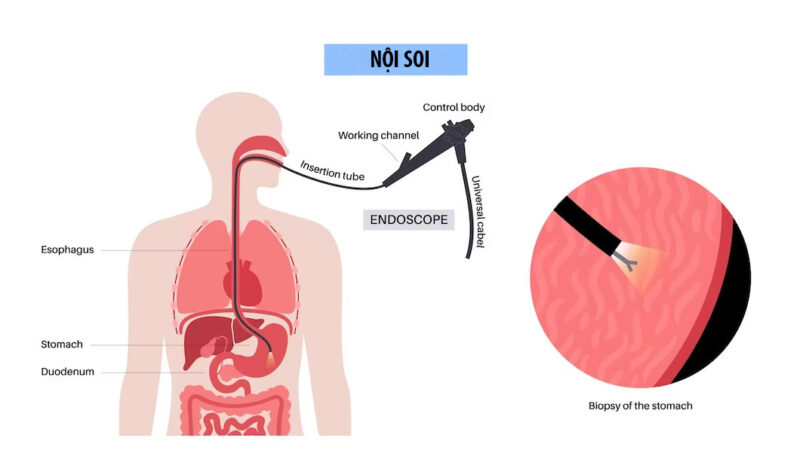 Ống soi đi vào dạ dày giúp bác sĩ quan sát và đánh giá các tổn thương