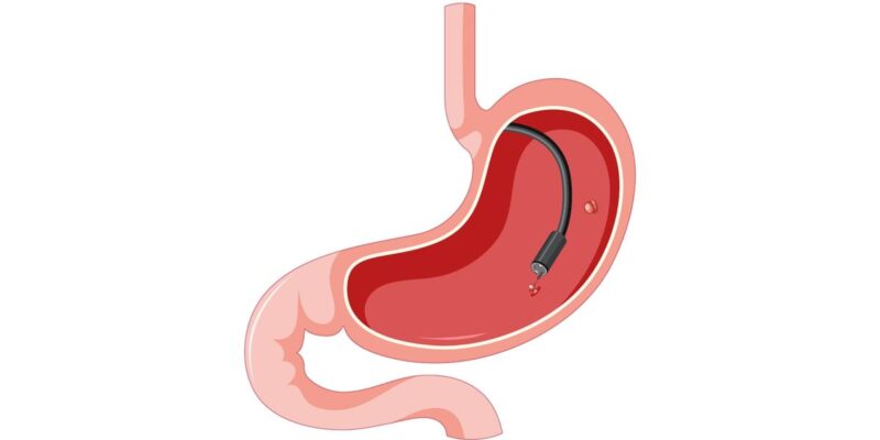 Nội soi giúp chẩn đoán hiệu quả nhiều bệnh lý tại dạ dày