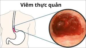 Viêm thực quản là một trong các bệnh lý gây nuốt vướng 