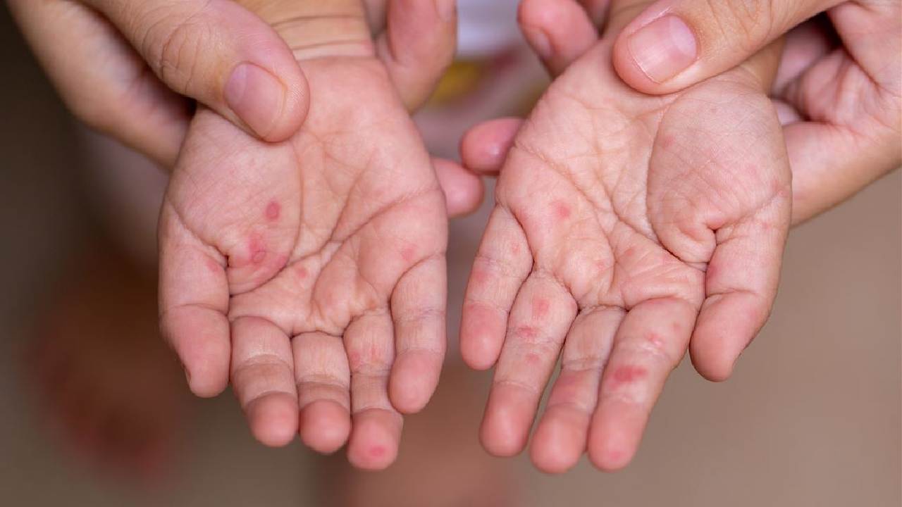Tay chân miệng là căn bệnh do virus đường ruột gây ra và thường gặp nhất ở nhóm trẻ dưới 5 tuổi