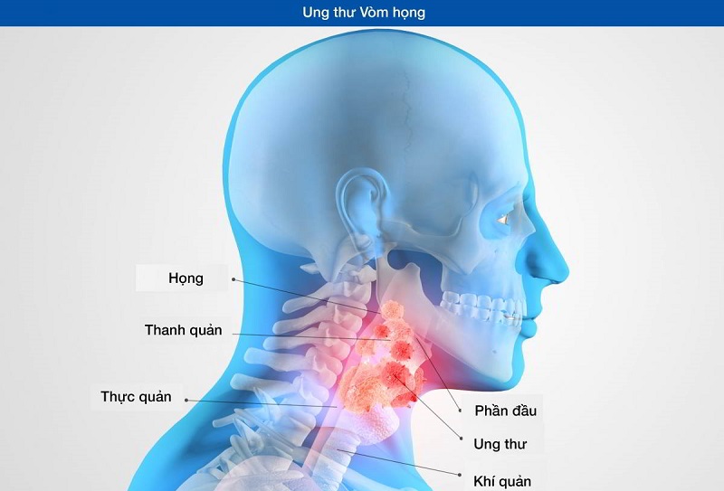 Ung thư vòm họng giai đoạn đầu (giai đoạn sớm) là thời điểm các tế bào ung thư mới xuất hiện tại vùng vòm mũi họng