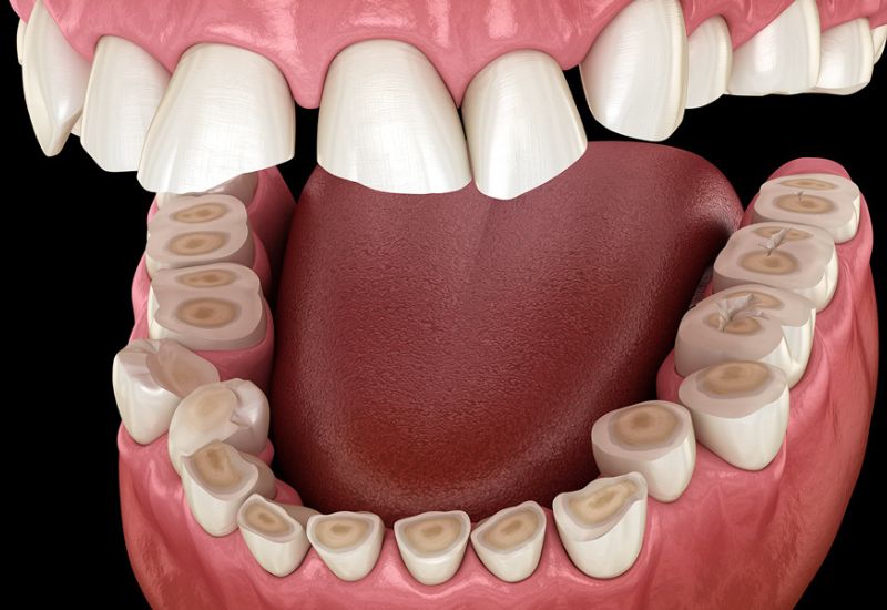 bị nghiến răng có dán sứ veneer được không