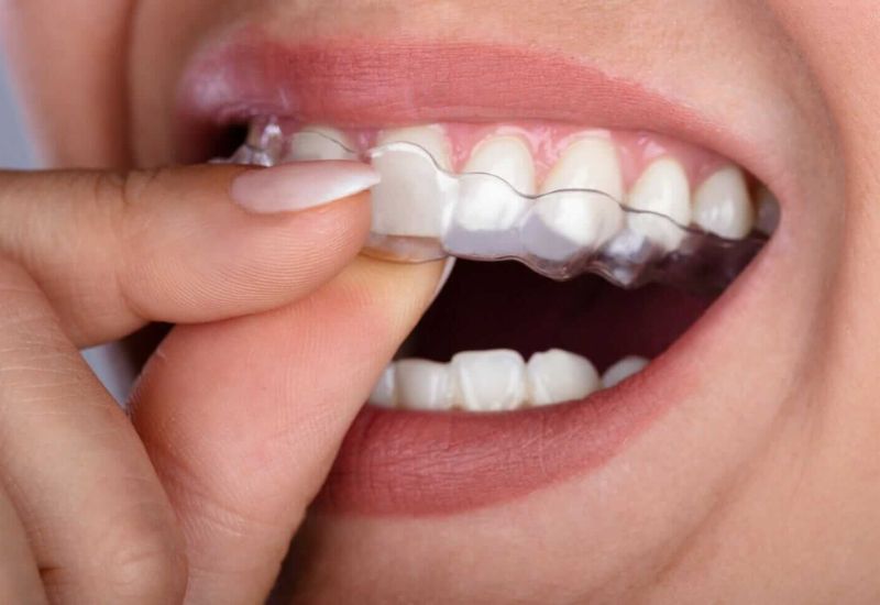 bị nghiến răng có dán sứ veneer được không