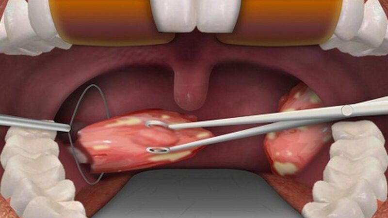 cắt amidan mấy ngày hết đau