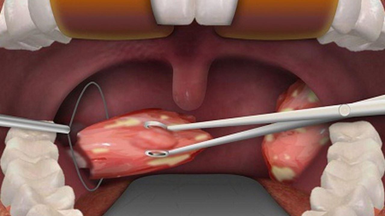 Quá trình cắt amidan có gây mê không?