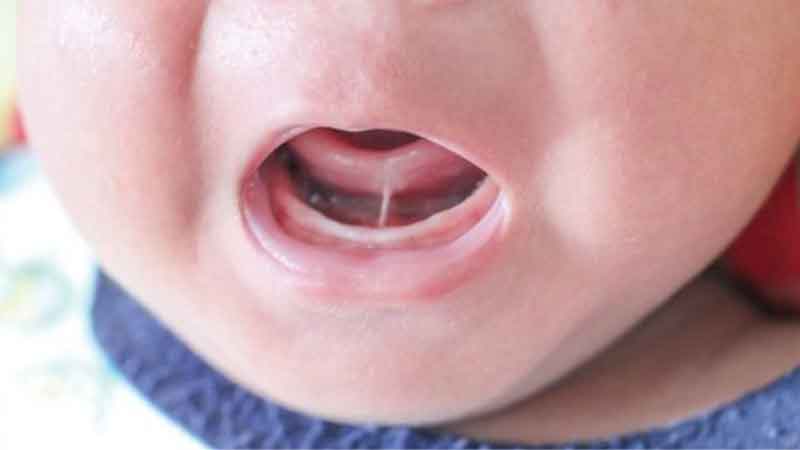 Cắt thắng lưỡi có sốt không