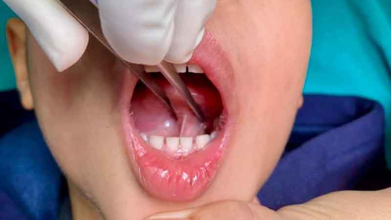 Bé cắt thắng lưỡi có cần nhịn ăn không? Bao lâu thì ăn được