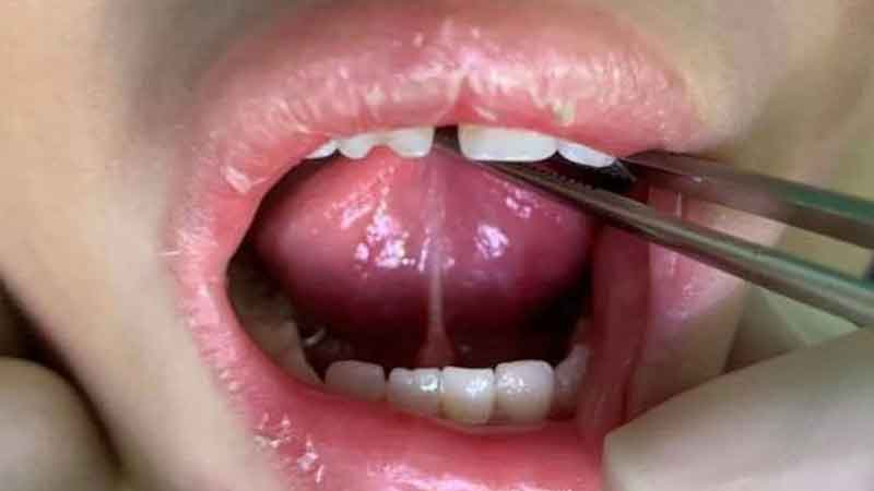 Cắt thắng lưỡi có sốt không