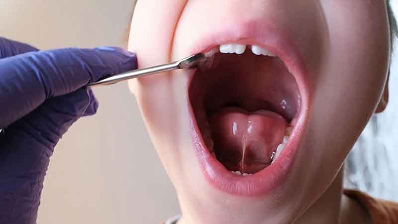 Bé cắt thắng lưỡi có cần nhịn ăn không? Bao lâu thì ăn được