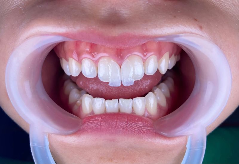 dán sứ veneer có cần mài răng không